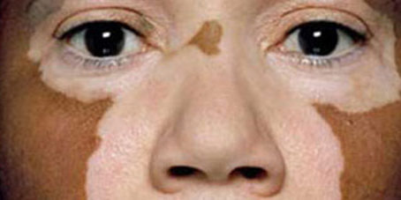 featureslider_vitiigo