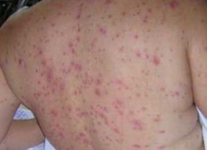 fiebre-3