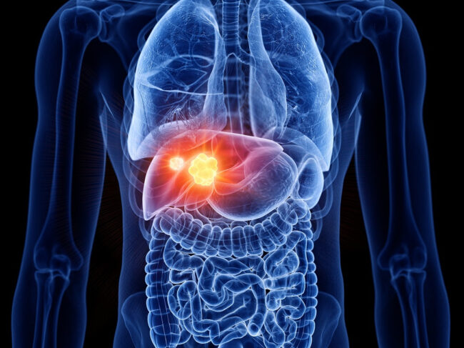 3d rendered medically accurate illustration of liver cancer